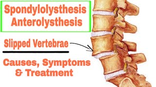 Spondylolisthesis or Anterolisthesis Causes symptoms and Treatment in UrduHindi [upl. by Isaiah99]