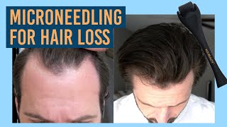 How I do my Microneedling  Derma Rolling for my Hair Loss [upl. by Swart]