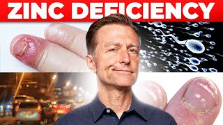 Zinc Deficiency The 7 Symptoms Youve Never Heard About [upl. by Anna-Diane]