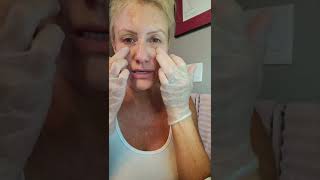 Getting better at Meso Mesotherapy with Miracle L  PCL DIY Facial [upl. by Gabor]