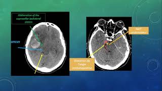 interprétation facile de tdm cérébral aux urgences [upl. by Lauren]