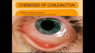 ENDOPHTHALMITIS SIMPLIFIED [upl. by Hammel475]