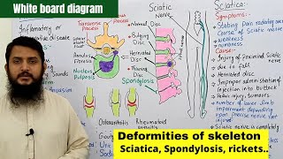 Deformities of skeleton part 02  Disc Slip  Spondylosis  Sciatica  Arthritis [upl. by Oryaj]