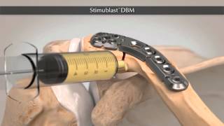 StimuBlast® Demineralized Bone Matrix DBM [upl. by Ahseined562]