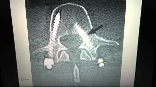 Spinal Implants Pedicle screws [upl. by Ane]