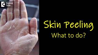 What causes skin peeling from fingers and feet How to manage  Dr Rasya Dixit [upl. by Annadal]