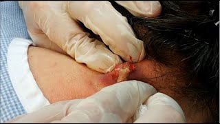 Boil  Cyst Removal Surgery [upl. by Dolhenty]