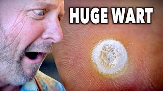 HUGE DECAYING WART Frozen With Liquid Nitrogen  Dr Paul [upl. by Aimet]