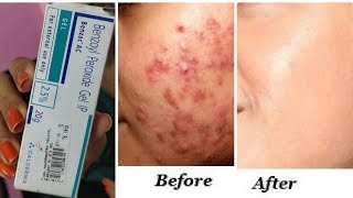 इससे होंगे पिंपल्स खत्म  Clear Acne Pimples once and for all  best solution for acne RabiaSkincare [upl. by Ayikan]