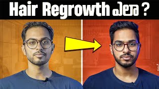 How I got my HAIR back  FULL GUIDE on Minoxidil Telugu [upl. by Spiegleman]