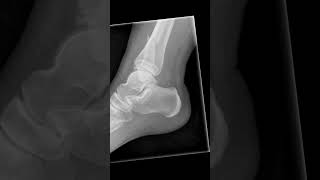 SalterHarris type IV fracture xray ankle shoets [upl. by Gleason726]