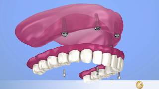 Implantologie Fester Zahnersatz mit AllOn4Implantat im Oberkiefer [upl. by Oba297]