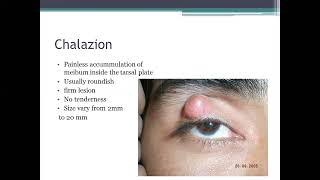 Understanding Eyelid Swellings A Comprehensive Guide to Hordeolum Chalazion Stye and Blepharitis [upl. by Nuli]