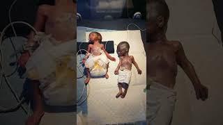 Twins  Twin Pregnancy  Babies in the womb  Multiple Pregnancy shortsfeed twins baby fyp [upl. by Eimmas]