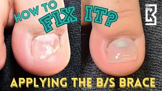 How to Pedicure BS Brace Application for Curving or Ingrown Nails [upl. by Wileen]