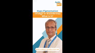 What Is Hypopigmentation  Dr Ravichandran G [upl. by Stamata]