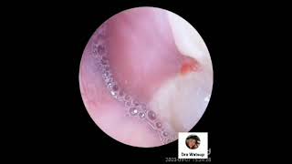 oralprophalaxis periodontology patient undergoing interproximal mucinous placks removal [upl. by Oab]