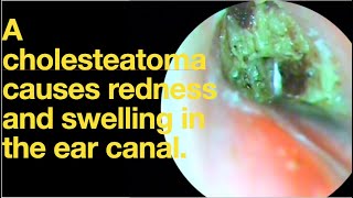 A cholesteatoma causes redness and swelling in the ear canalear wax removal  ear cleaning  ASMR [upl. by Bolanger366]