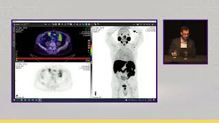 PSMA PETCT Tumor Board  MultiDisciplinary Meeting Live at ProsTIC22 [upl. by Atinaujnas23]