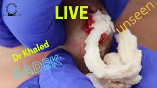 Multiple Cyst Removal Part 2 Dr Khaled Sadek LipomaCystcom [upl. by Aurita]