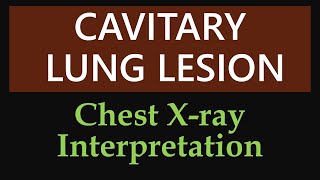 Cavitary Lung Lesion  Chest Xray Interpretation [upl. by Llamaj]