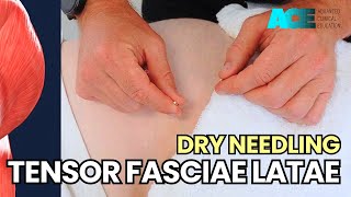 Dry Needling Tensor Fasciae Latae [upl. by Leelahk670]