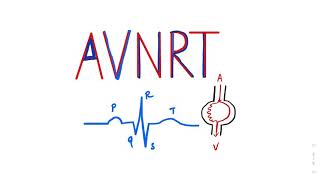 Atrioventricular Nodal Reentrant Tachycardia AVNRT SVT ecgtutorial cardiology AVRT Arrhythmia [upl. by Trik]