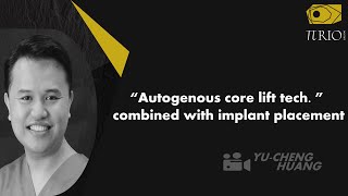 “Autogenous core lift tech ” combined with implant placement [upl. by Xymenes]