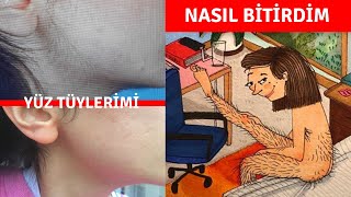 Yüz Tüylerimden İğneli Epilasyonla Nasıl Kurtuldum [upl. by Childs]