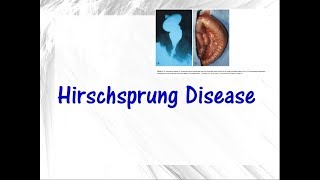 Hirschsprung disease [upl. by Rodina838]