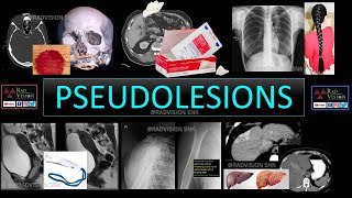 PSEUDOLESIONS [upl. by Camilia]