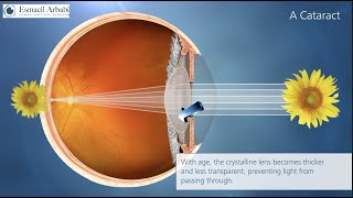 What is Cataract Animation high quality video [upl. by Ushijima11]