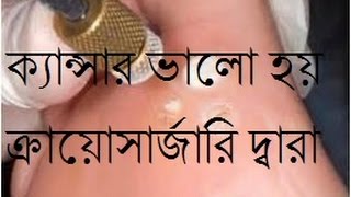 HSC ICT Lecture 6  Cryosurgery ক্রায়োসার্জারি Cryoscience and Cryomedicine [upl. by Ellohcin]