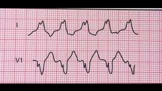 Tachycardie ventriculaireMorphologie du bloc de branche gauche [upl. by Ahsenroc]