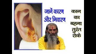 कान बहने की समस्या को घरेलू उपचार से करें दूर  Otorrhea Treatment in Ayurveda [upl. by Dibri973]