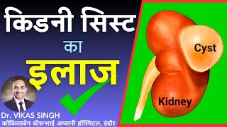 Kidney Cyst Treatment ✅ Kidney ki gathan ka ilaaj Renal Cyst  By Dr Vikas Singh Urologist [upl. by Amitie]