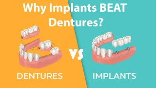 Dentures Versus Dental Implants Which is Right for You  DentaVacation [upl. by Ahsiloc]