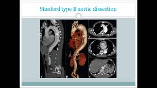 Cardiac CT scan  3D CT angiogram basic overview use contrandications findigns for USMLE [upl. by Shyamal]