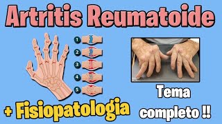 ARTRITIS REUMATOIDE  sintomas tratamiento  FISIOPATOLOGIA [upl. by Ytinav]