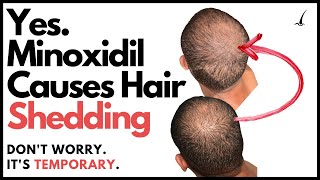 Does Minoxidil Make You Go Bald The TRUTH about Minoxidil Hair Shedding Phase [upl. by Robina]