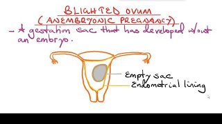 Blighted Ovum Anembryonic pregnancy [upl. by Aushoj329]