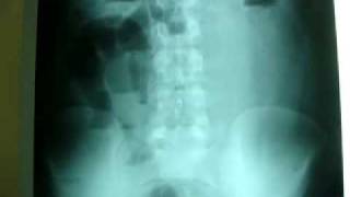 Intestinal Obstruction after Previous Surgery [upl. by Buck]