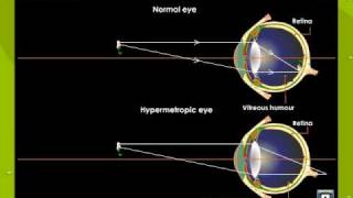 Hypermetropia or Hyperopia [upl. by Meece]