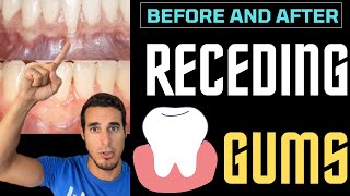 RECEDING GUMS  Before and after [upl. by Kay]