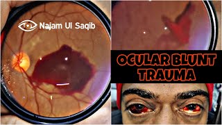 Blunt Ocular Trauma  Subconjunctival Hemorrhage  Macular Boat Shaped Vitreous Hemorrhage [upl. by Hamil]