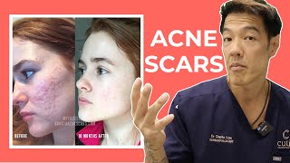 The Best Acne Scar Treatments Explained  Dr Davin Lim [upl. by Howlyn]