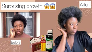 Surprising Results😱 My Hair Growth Journey with bayrum bergamot placenta  Debiee O [upl. by Solana181]