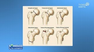 Il Mio Medico  Fratture del femore come si riconoscono [upl. by Enalahs]
