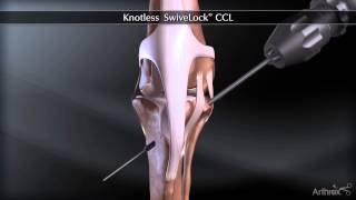 Knotless Swivelock® CCL [upl. by Ahsienroc158]