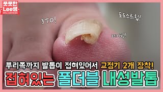 ENG SUB뿌리쪽까지 접혀있는 폴더블 내성발톱 고객님은 교정기 2개 장착 ingrown toenail  Fresh Foot 성수점  남양주호평점 [upl. by Azalea]